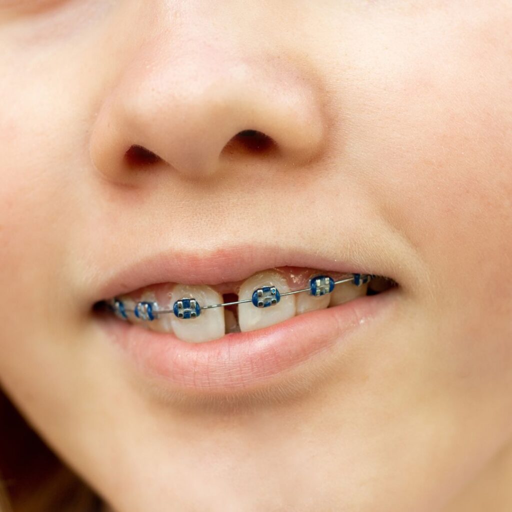 diastema